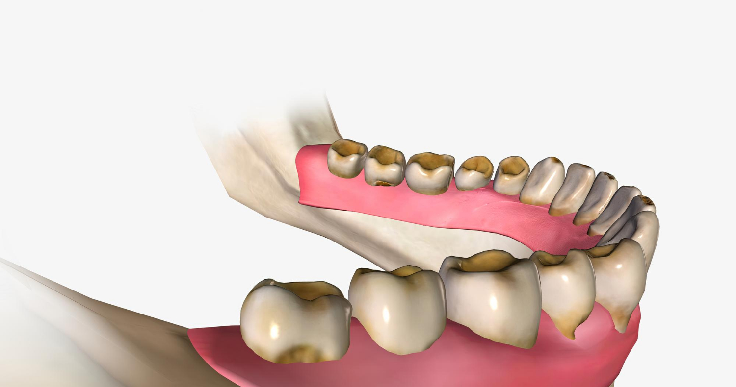 tooth-erosion